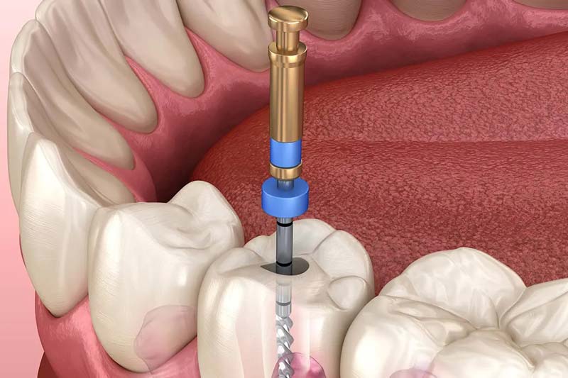 چرا عصب کشی دندان در صادقیه تهران را انتخاب کنیم؟