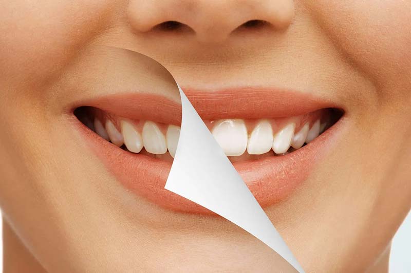 عوامل موثر بر هزینه بلیچینگ دندان در صادقیه چیست؟