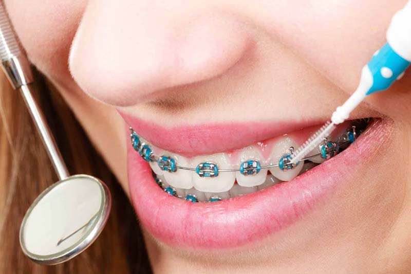 چه عواملی بر هزینه ارتودنسی دندان تاثیر می گذارند