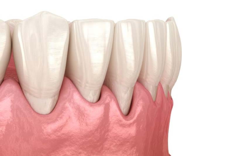 چه عواملی تعیین کننده هزینه جراحی لثه است؟