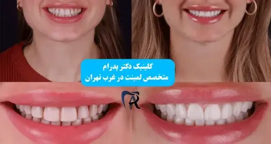 قبل و بعد لمینت دندان در صادقیه - کلینیک دکتر پدرام