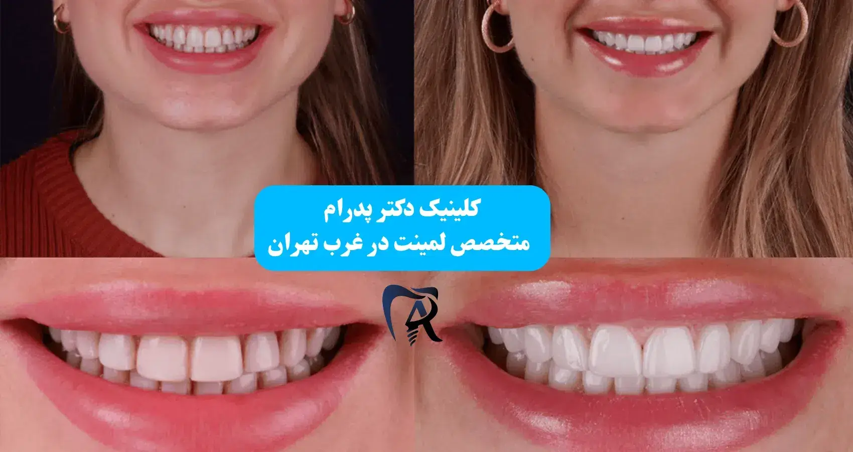 قبل و بعد لمینت دندان در صادقیه - کلینیک دکتر پدرام