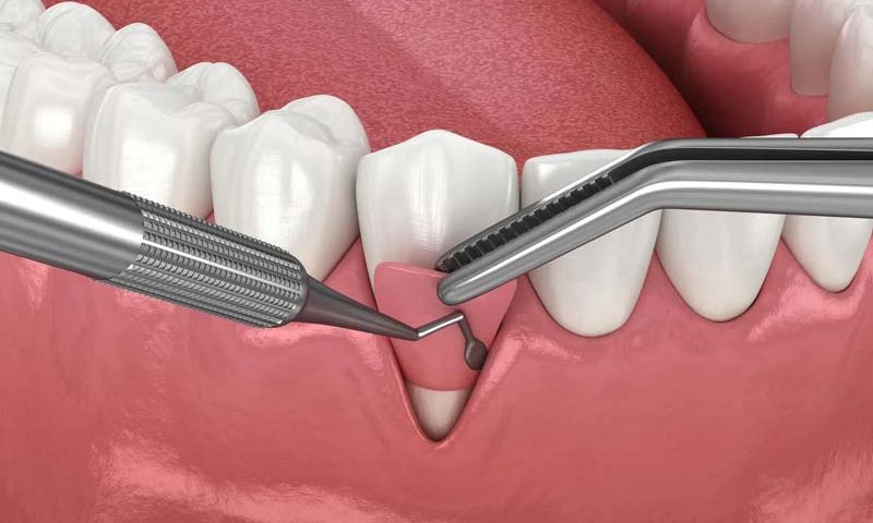 جراحی لثه در صادقیه تهران