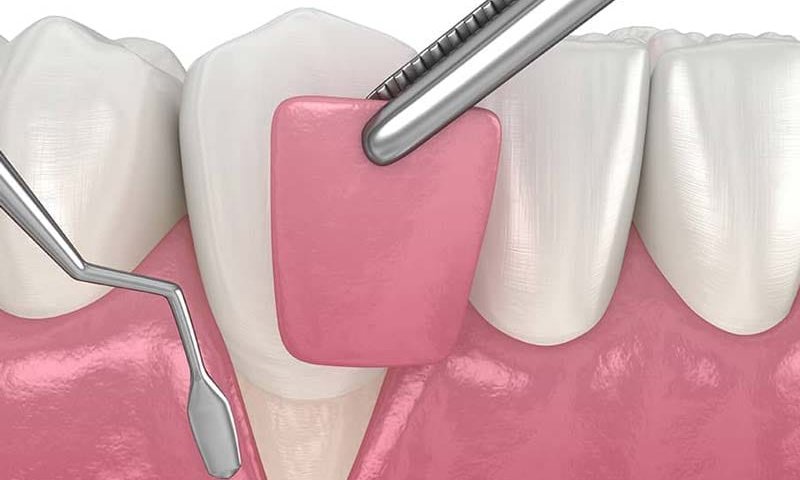 جراحی لثه در غرب تهران