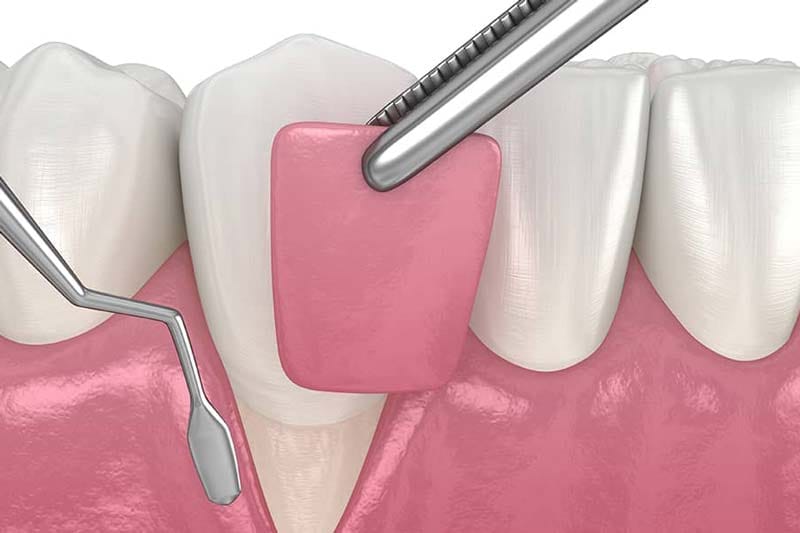 جراحی لثه در غرب تهران