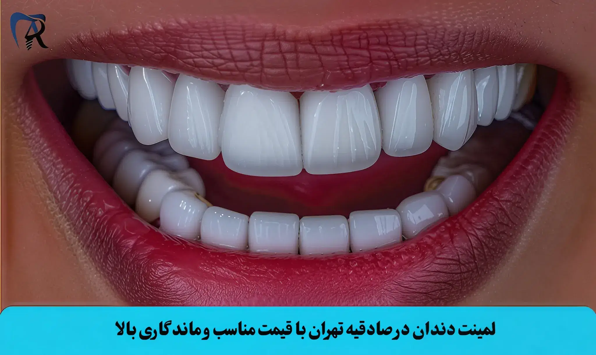 لمینت دندان در صادقیه تهران با قیمت مناسب و ماندگاری بالا
