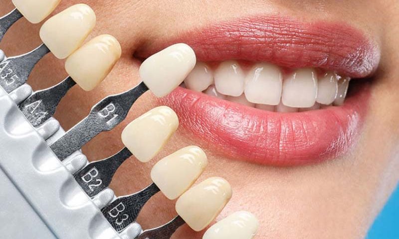 درمان لمینت دندان چند جلسه و چقدر زمان لازم دارد؟