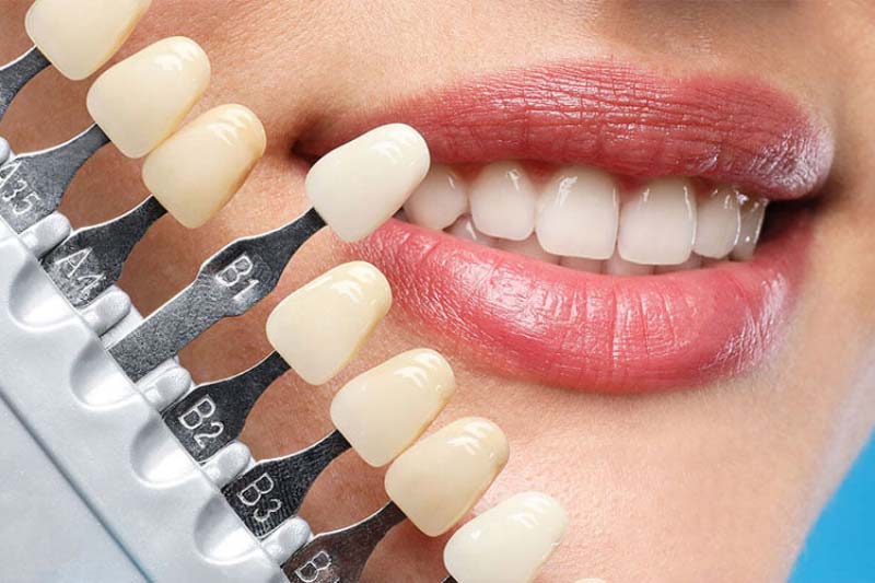 درمان لمینت دندان چند جلسه و چقدر زمان لازم دارد؟