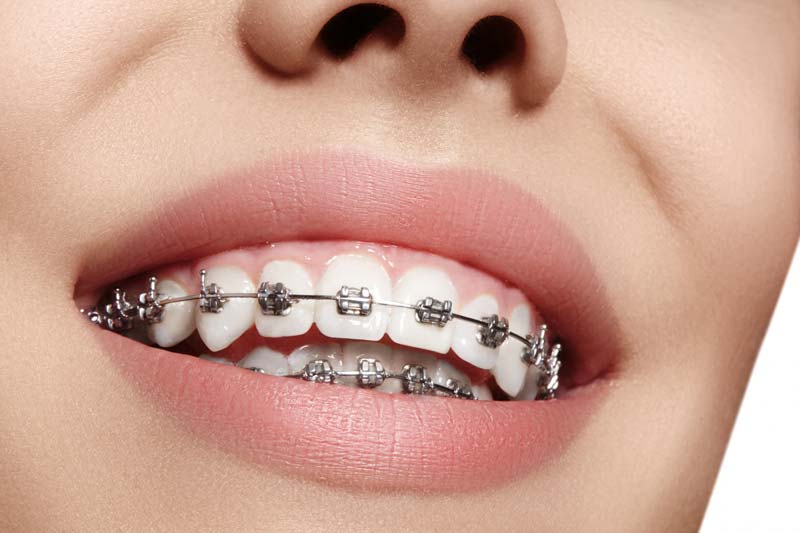 مراحل انجام ارتودنسی دندان چیست؟