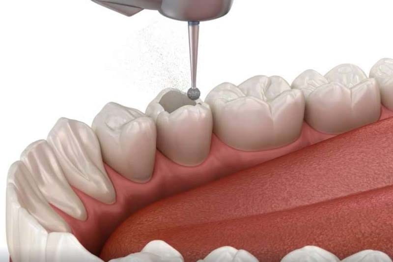 چرا نیاز به عصب کشی و یا درمان ریشه داریم؟