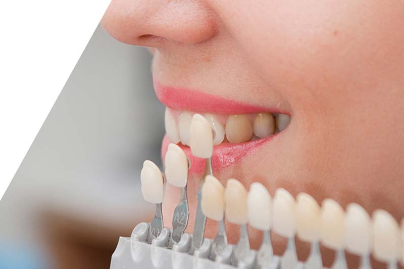 هزینه لمینت دندان در صادقیه چند است؟