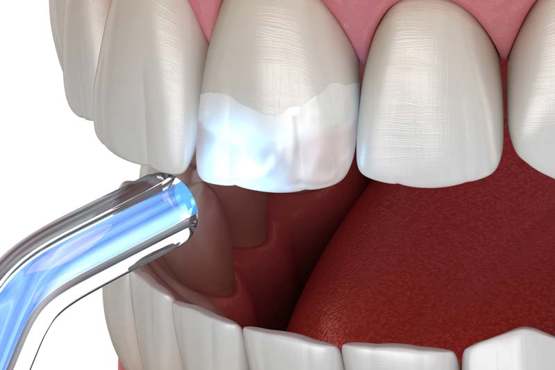 نکات و مراقبت های بعد از کامپوزیت دندان در غرب تهران