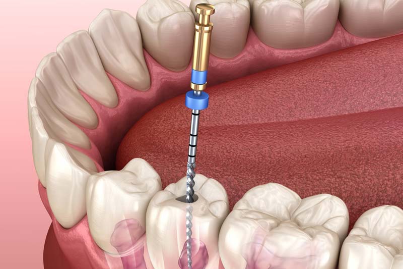 مراحل و مزایا عصب کشی دندان چیست؟