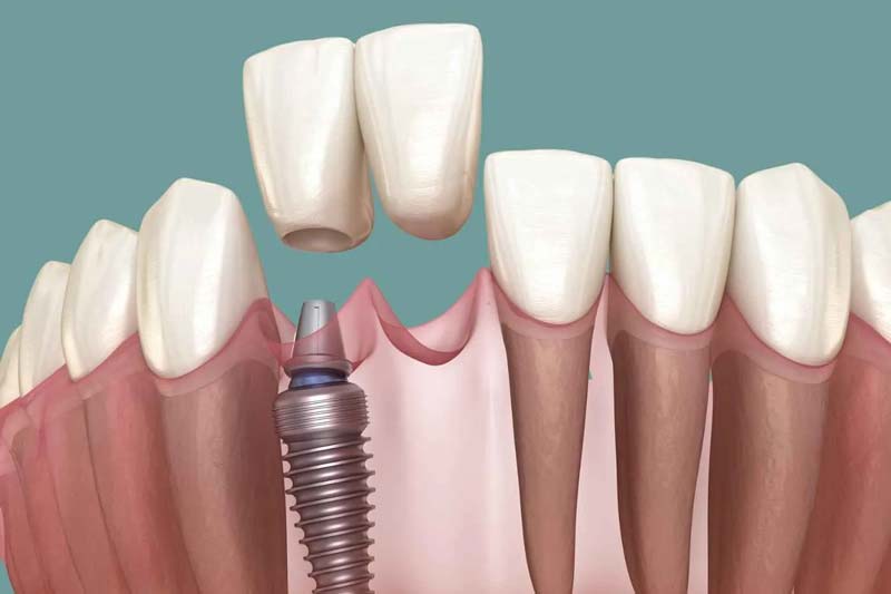 مراحل کاشت ایمپلنت دندان در صادقیه در کلینیک دکتر امیررضا پدرام