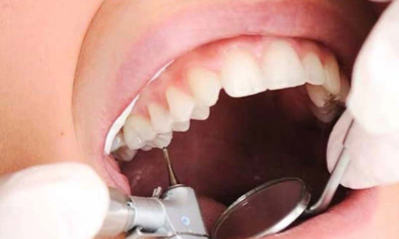 پر کردن دندان با عصب کشی