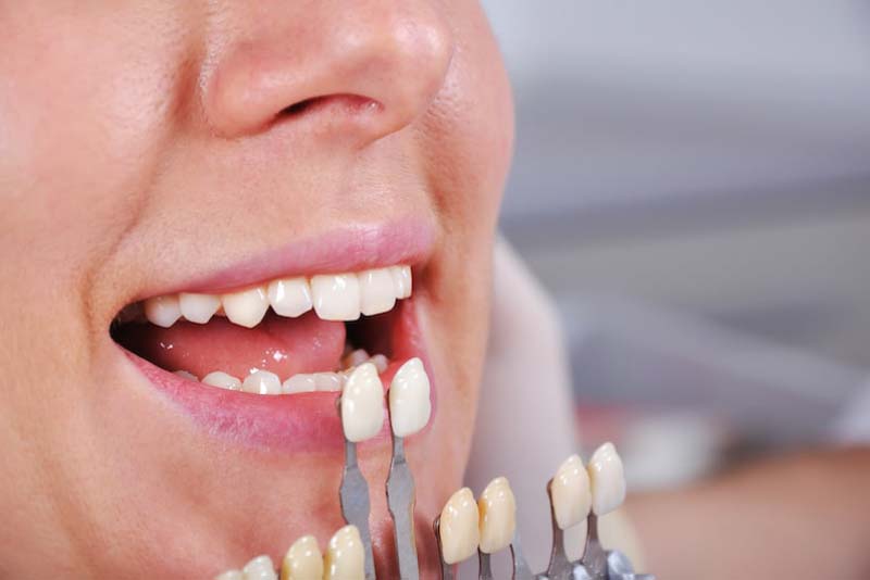 تزاش دندان برای لمینت چه مزایا و معایبی دارد؟