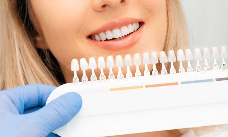 تراشیدن دندان برای لمینت