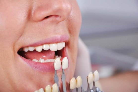 تزاش دندان برای لمینت چه مزایا و معایبی دارد؟