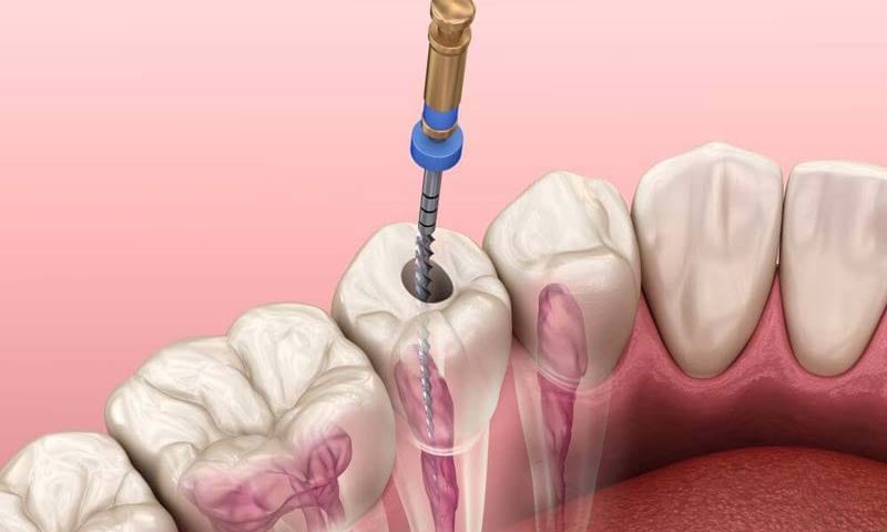 زمان عصب کشی دندان