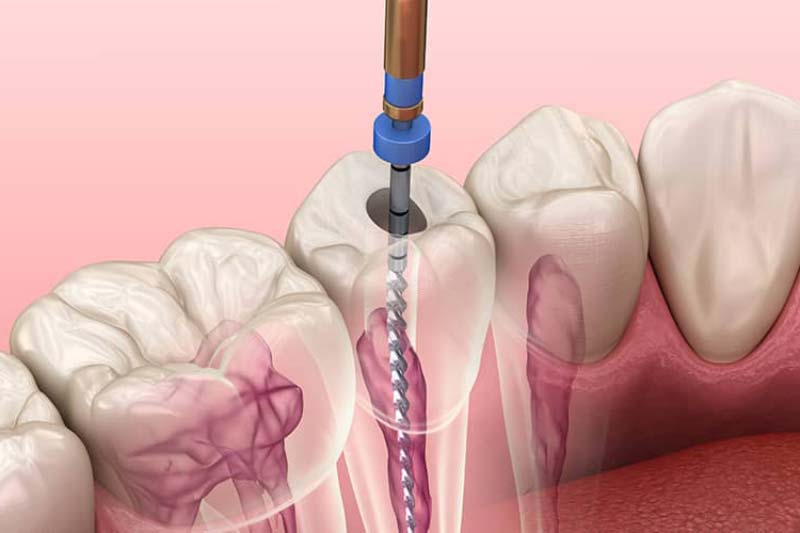 برای عصب کشی نیاز به چند جلسه داریم؟