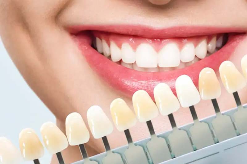 چه عواملی بر تصمیم گیری برای انجام لمینت دندان تاثیر گذار است؟