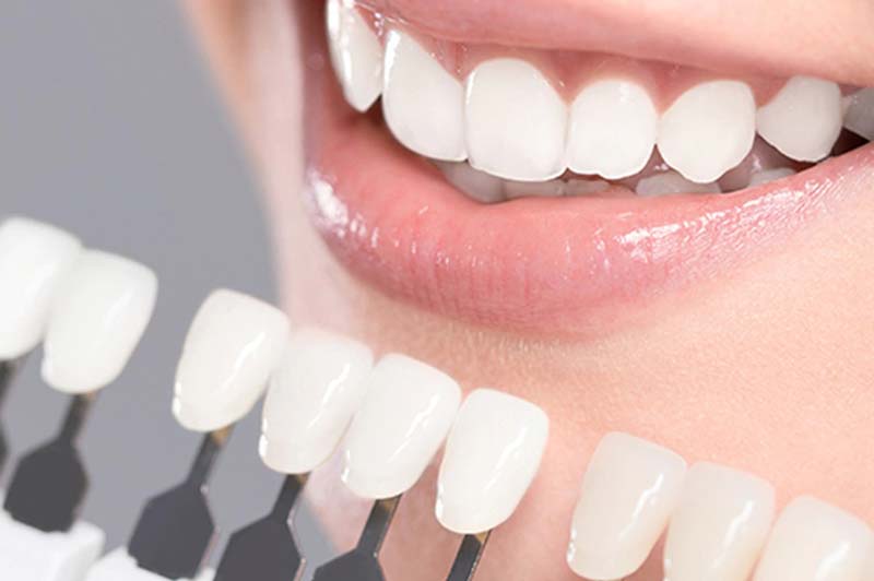 فرآیند نصب لمینت دندان