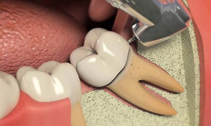 علائم نیاز به عصب کشی دندان