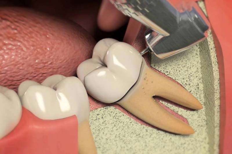 علائم نیاز به عصب کشی دندان