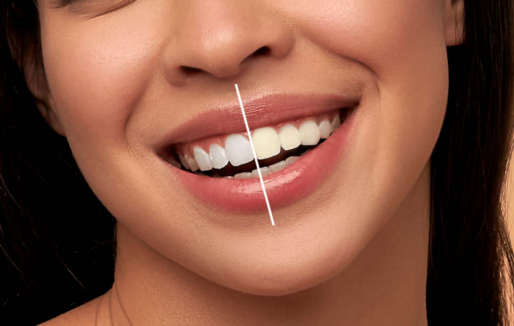 آیا بلیچینگ می تواند آسیب‌های احتمالی به مینا دندان شود؟