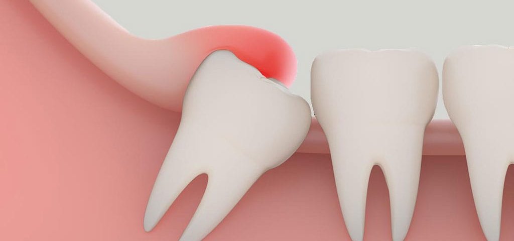 عفونت دندان عقل