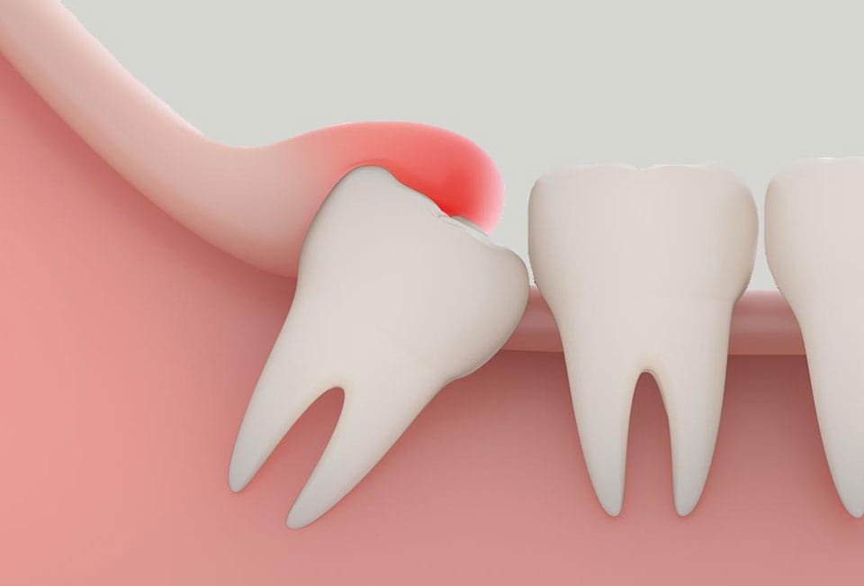 عفونت دندان عقل