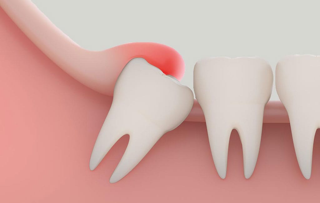 چطور از عفونت بعد از کشیدن دندان عقل جلوگیری کنیم؟