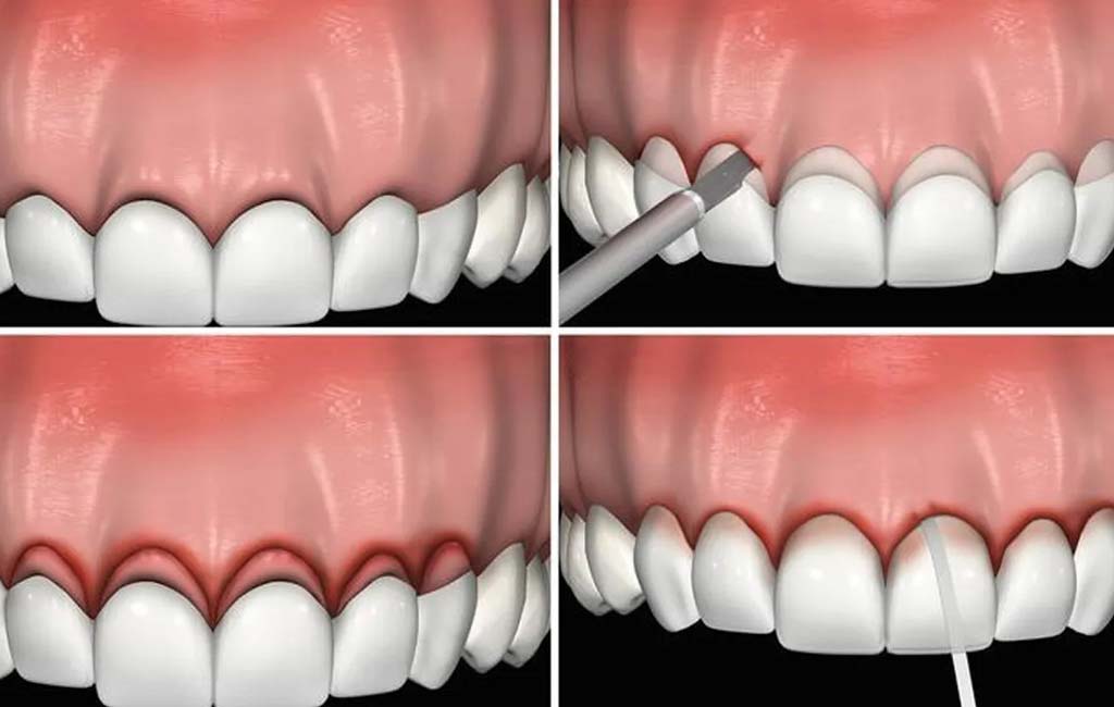 مراحل انجام جراحی لیفت لثه و مراقبت های آن