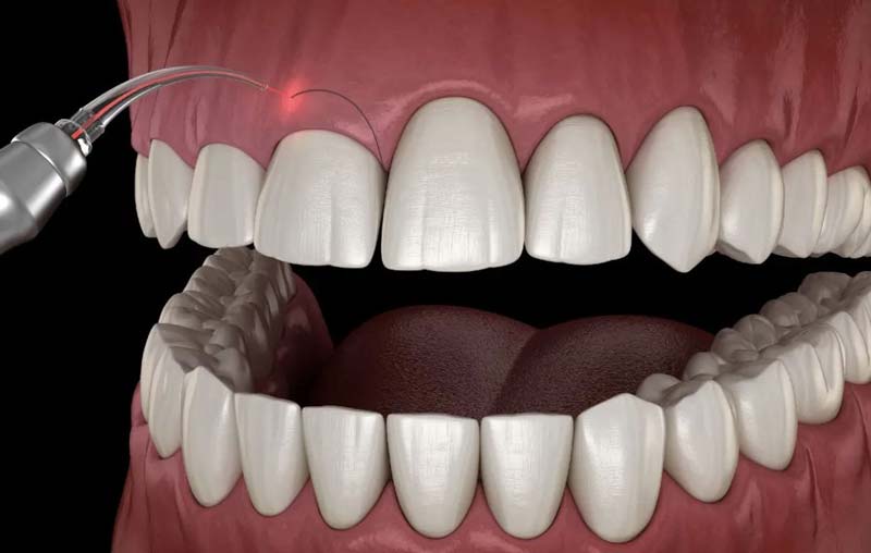 چرا باید جراحی لیفت لثه انجام داد؟