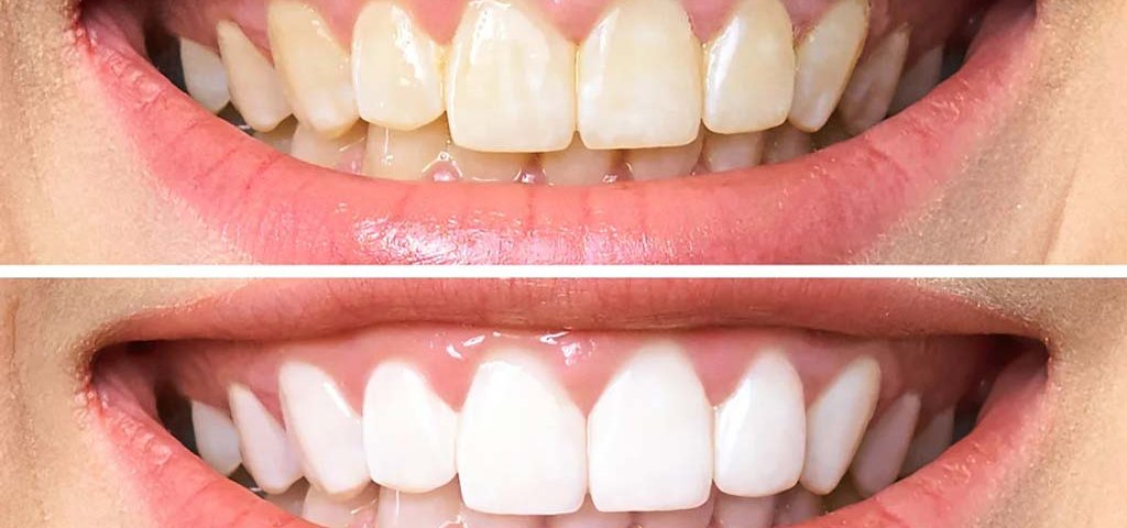 آیا بلیچینگ دندان‌ها باعث آسیب به مینا دندان می‌ شود؟