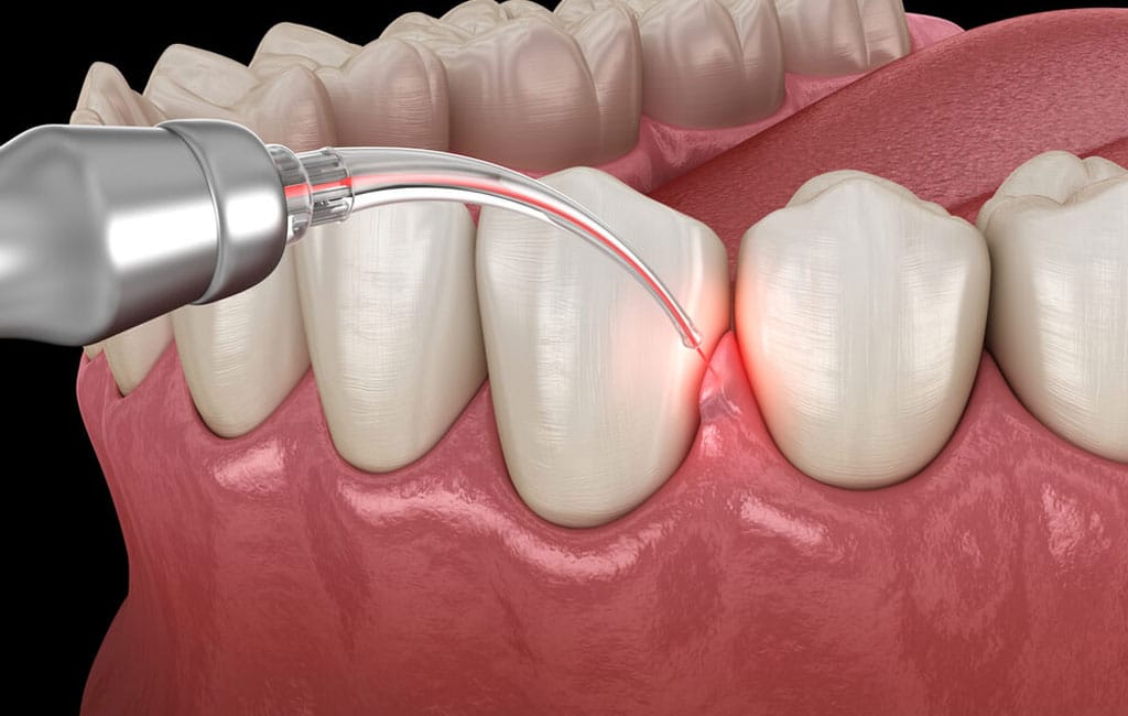 مزایای جراحی لثه با لیزر چیست؟