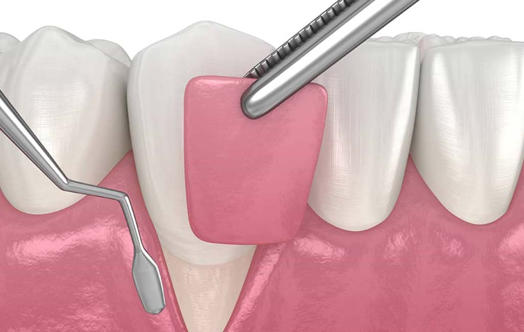 انواع جراحی لثه و نحوه مدیریت هزینه آن