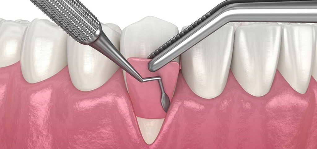 هزینه جراحی لثه چقدر است؟