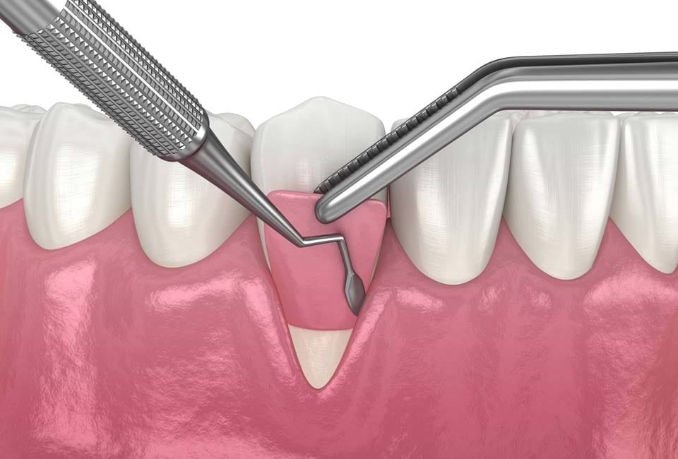 هزینه جراحی لثه چقدر است؟