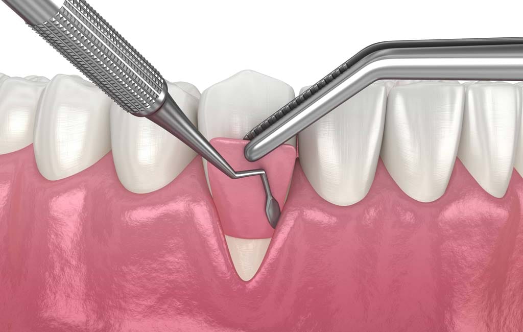 هزینه جراحی لثه چقدر است؟