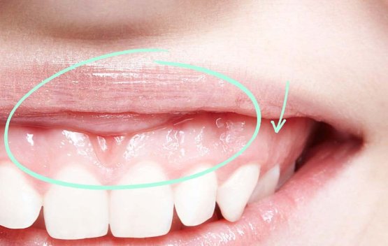 نحوه جراحی لیفت لثه و مراقبت های آن