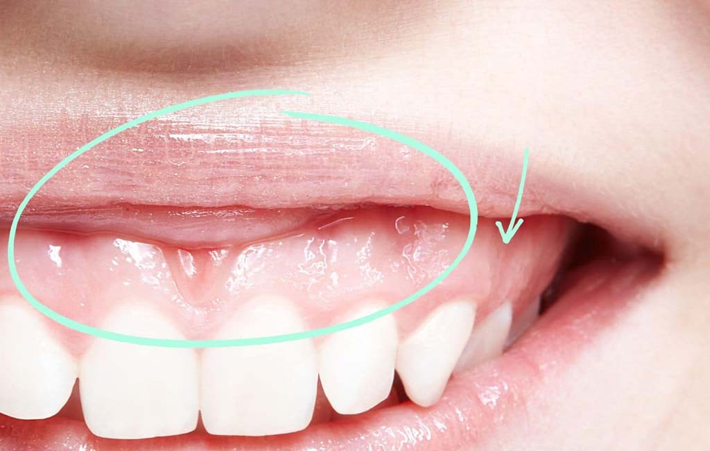 نحوه جراحی لیفت لثه و مراقبت های آن