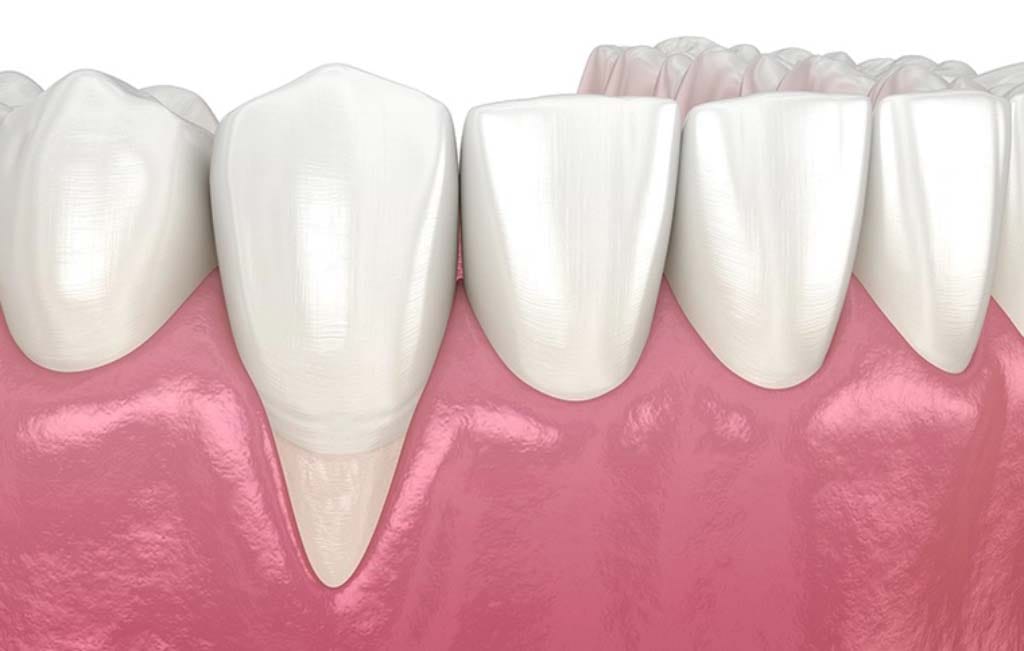 هزینه جراحی لیفت لثه