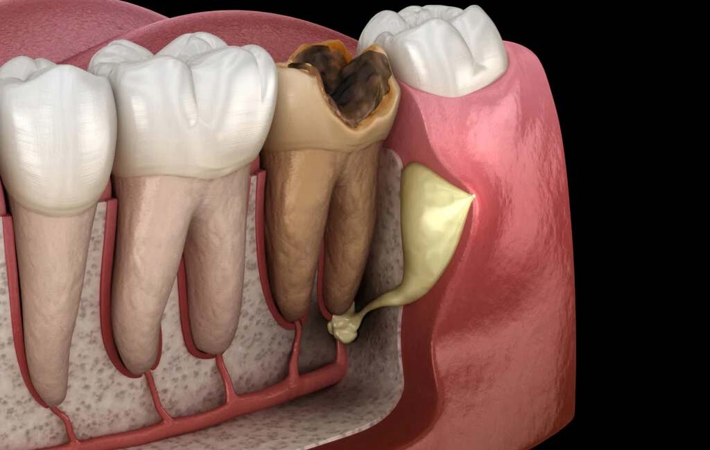 چه زمانی به جراحی فلپ لثه نیاز است؟