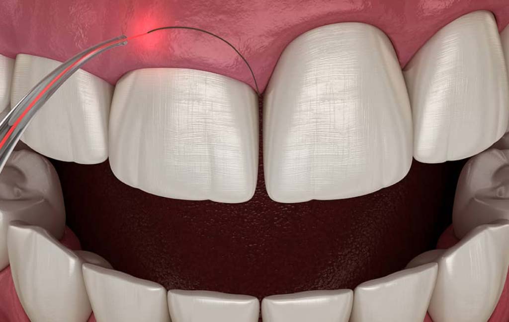 چه عواملی بر هزینه جراحی لثه تاثیر می گذارند؟