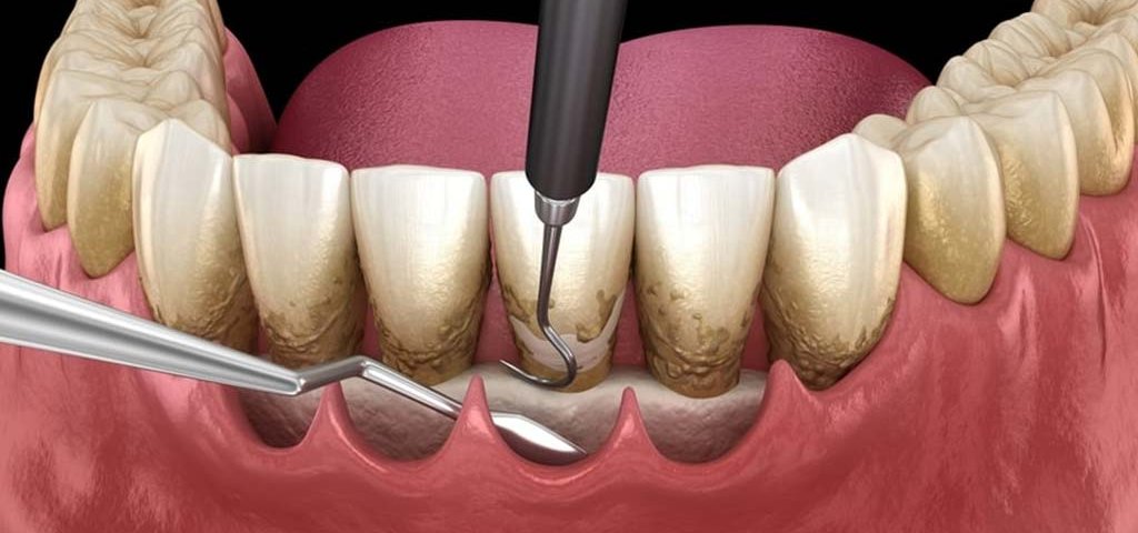 جراحی فلپ لثه چیست؟