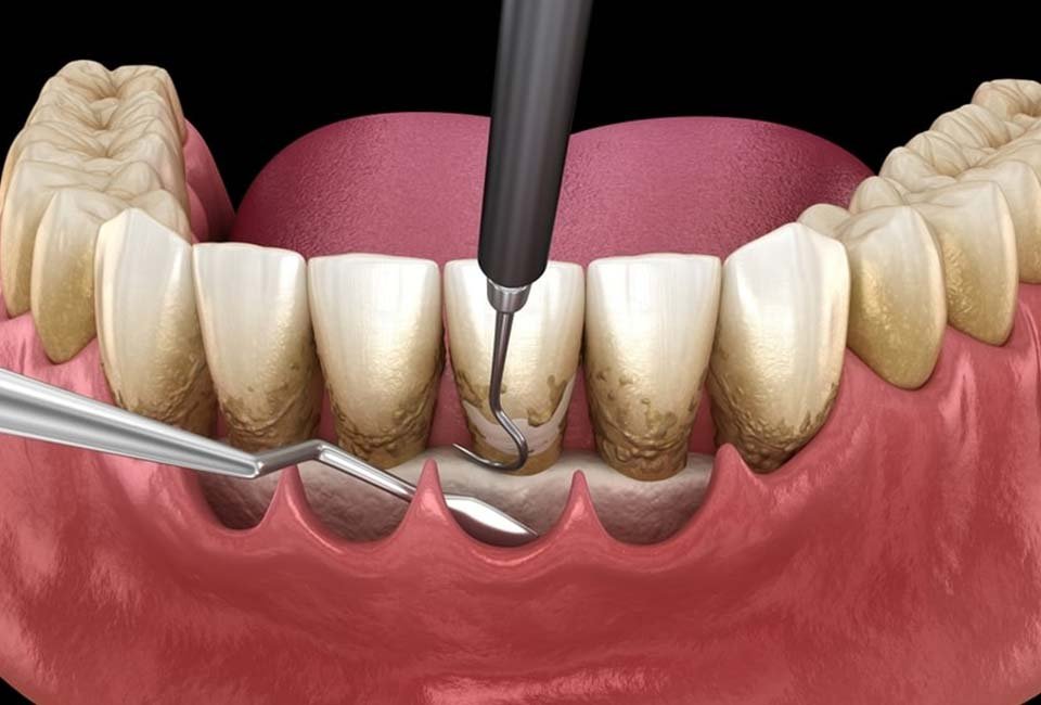 جراحی فلپ لثه چیست؟