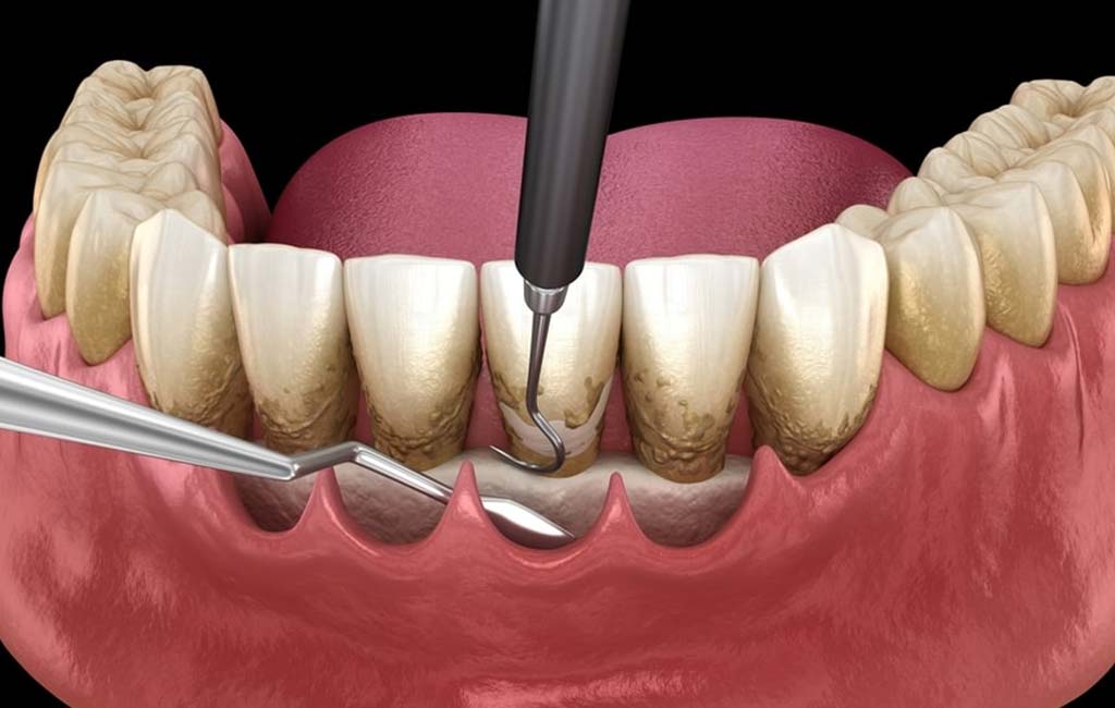 جراحی فلپ لثه چیست؟