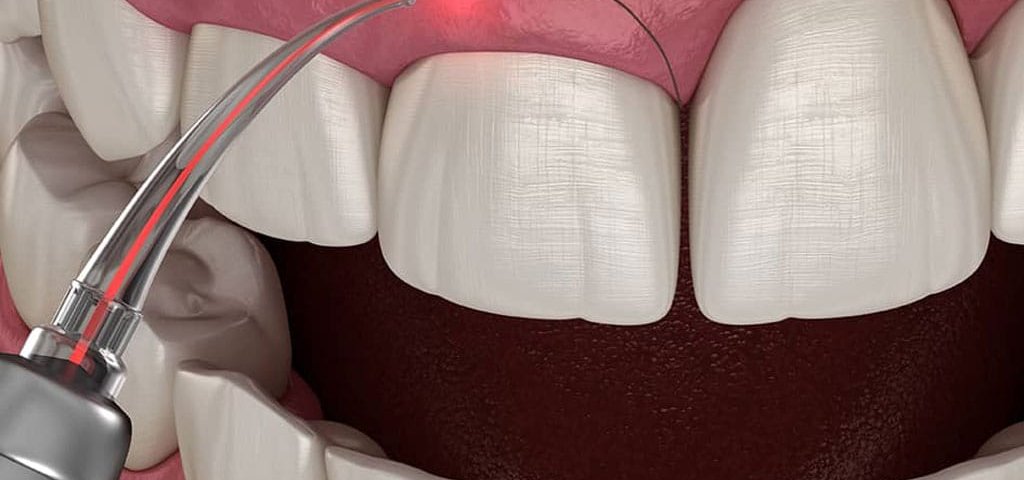 جراحی لثه با لیزر