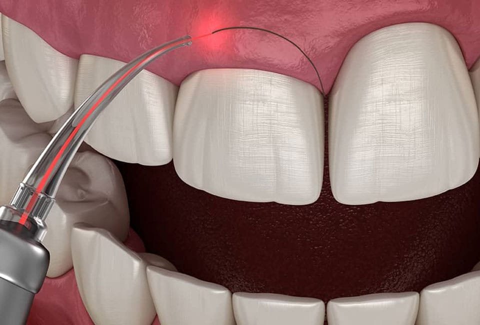 جراحی لثه با لیزر